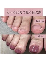 ティアラネイル(tiaranail)/再発させない深爪矯正