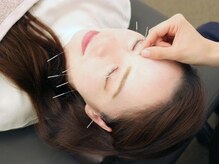 三国駅前ビューティー鍼灸院(三国駅前Beauty鍼灸院)/美容鍼で小顔に