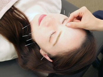 三国駅前ビューティー鍼灸院(三国駅前Beauty鍼灸院)/美容鍼で小顔に