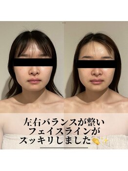 ラノン(LANON)/ビフォーアフター6