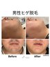 【モニター募集】男性ヒゲ脱毛 10回分（限定3名）¥100,000 → ¥55,000
