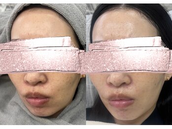 モガナ(mogana)/フェイスクリーニング1回