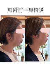 シンナリ(Shinnari)/施術前→施術後