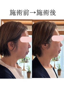 シンナリ(Shinnari)/施術前→施術後