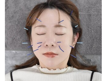 アキュリラ(Acurela)の写真/西洋×東洋の技術の融合◆痛みのない最高峰の美容鍼灸でむくみ・しわの改善◎年齢の印象が変わる美小顔施術