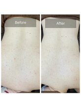 ハーブピーリング【背中 ニキビ 毛穴ケア】EMILUCA 天王寺店 /ウエディングで見せれる背中へ