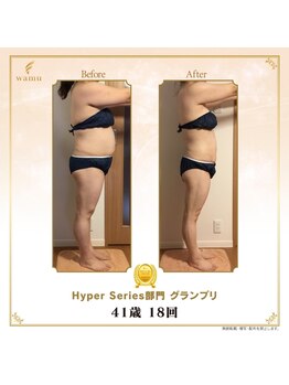 タノソイネ(tanosoine)/【41歳ハイパーナイフ痩身変化】