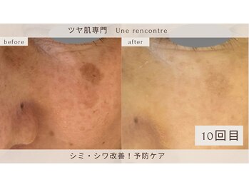 ユヌランコント 岐阜店(Une rencontre)の写真/40代必見！エンビロンとハーブピーリングでシミシワ改善、透明感あふれる肌へ♪