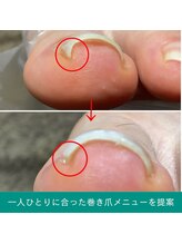 地爪ケアクリニックサロン 仙台/【巻爪でお悩みの方に】