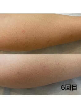 モルト(MOLT)/ふくらはぎ裏