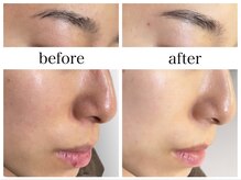 アリエス/ハイドラ×美白フォト10回の変化