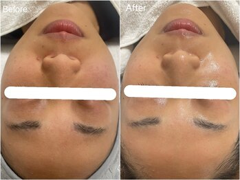 ルーナ 恵比寿(Luna)/サーマル×リゼネレート