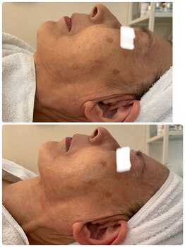 ボーテペズナズ(Beaute'Pezenas)/小顔、リフトアップ