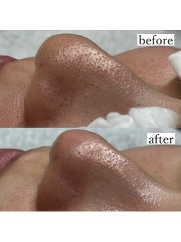 ライカブルー(RaicA BluE)/施術写真　before-after