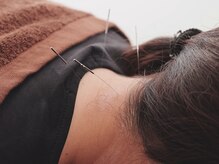 西宮しおり鍼灸整骨院 整体院/【鍼灸】