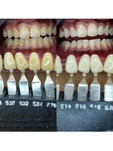 トウキョースワーズ 渋谷店(TOKYO SWRS)/#ホワイトニング #渋谷 #池袋