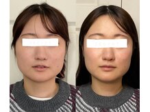 ブリリアント 西宮(Brilliant)/首元をしっかり緩めてお顔も◎