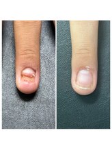 ヒューマン鍼灸接骨院/30％が深爪に悩んでいる