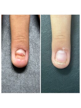 30%が深爪に悩んでいる