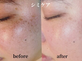 カピリナ(KA PILINA)/シミケアエステ