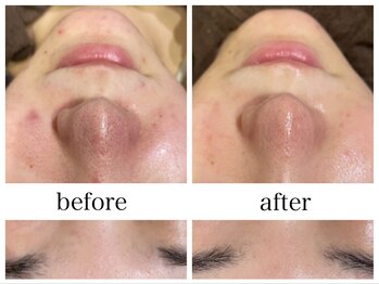 アリエス/【炎症毛穴】の肌質改善