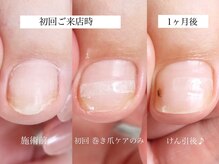 メイシンネイル(Meixingnail)/巻き爪矯正の経過目安です♪