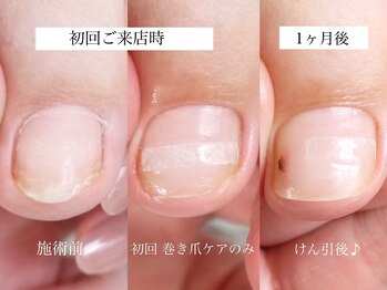 メイシンネイル(Meixingnail)/巻き爪矯正の経過目安です♪
