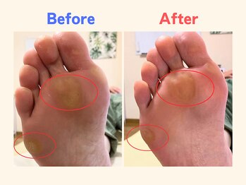 ピース/足裏のタコでお悩みの40代女性