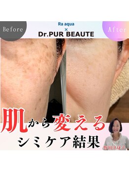 エステティックサロン ラ アクア(ra aqua)/小さなシミも逃さない肌育エステ