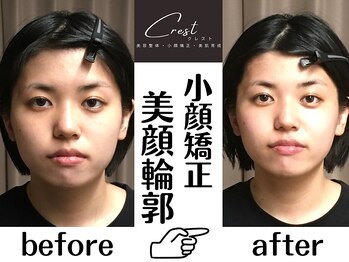 クレスト(CREST)/小顔矯正/頭蓋骨矯正/首肩矯正