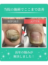 フルフィル 高田馬場店/分厚い爪・変形爪・深爪ケア