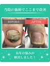 分厚い爪・変形爪・深爪ケア