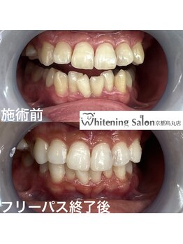 ホワイトニングサロン 京都烏丸店/ホワイトニン施術例