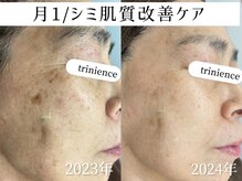 トリニエンス 新宿店(TRINIENCE)/50代/シミケア/肌代謝ケア