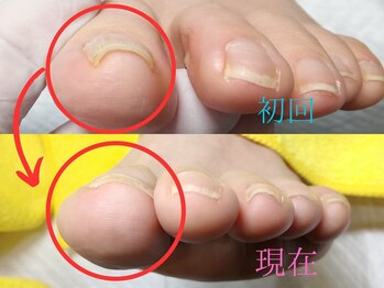 【巻き爪ケア】ネイル/フット