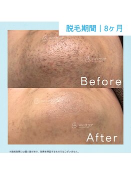 メンズクリア ららぽーと和泉店/【メンズクリア】お客様の施術例