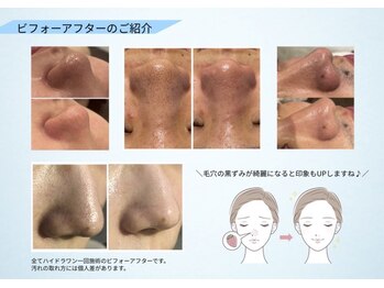 ラ・コンシェル 青葉台店(La Concier)/ハイドラ毛穴洗浄＠青葉台