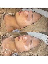 プライベートサロン レイ(Ray)/小顔コース