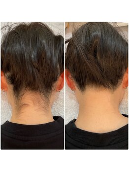 プレヴェール 神戸三宮/うなじ脱毛