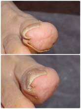 巻き爪じゅん 千葉駅前店/巻き爪に悩まない生活を取り戻す