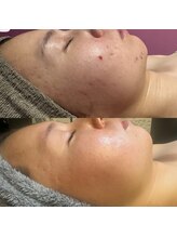 アルム(a'rme)/【ニキビ】