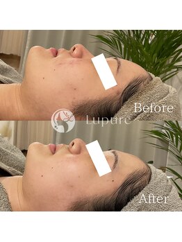 ルプレ(Lupure)/ハーブピーリング5回目