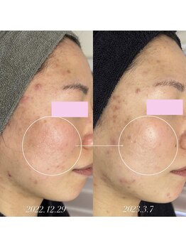 スピカ(Spica)/大人気!バクチ甦生プログラム