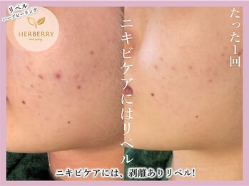 ハーバリー ハーブピーリング 難波心斎橋店(HERBERRYハーブピーリング)/なんばハーブピーリングHERBERRY