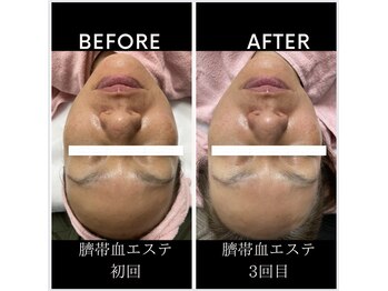 ランプシー(Lampsi)/臍帯血エステ