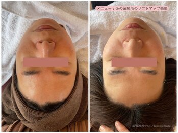 レスイズモア 恵比寿(less is more.)/金の糸脱毛の１回の変化