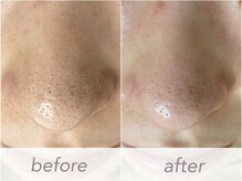 ウィル 二子新地(will)/毛穴ディープクリアケア