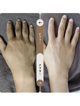ジュゴン(Dugong)/手の全体脱毛（Before＆After）