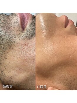 サロンリアンジュ ひたちなか店(Salon Liange)/めんどくさい髭剃りからの解放！