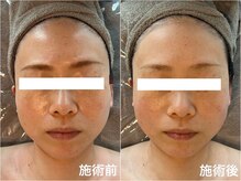 タオ(TAO)/施術写真：コルギ